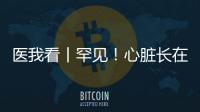 医我看丨罕见！心脏长在右胸膛�！珠海成功开展首例“右位心”房颤射频消融术